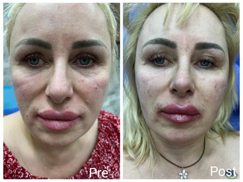 نتيجة-حقن-جاليبرو-بعد-حقنة-واحدة